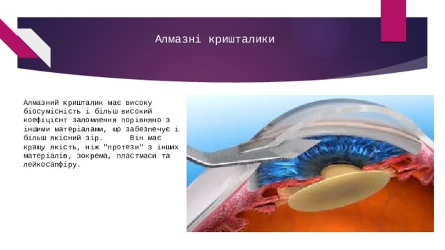 Алмазні кришталики Алмазний кришталик має високу біосумісність і більш високий коефіцієнт заломлення порівняно з іншими матеріалами, що забезпечує і більш якісний зір.      Він має кращу якість, ніж 