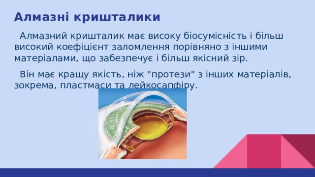 Алмазні кришталики  Алмазний кришталик має високу біосумісність і більш високий коефіцієнт заломлення порівняно з іншими матеріалами, що забезпечує і більш якісний зір.  Він має кращу якість, ніж 