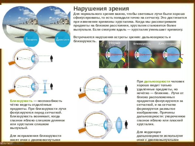 Нарушения зрения Для нормального зрения важно, чтобы световые лучи были хорошо сфокусированы, то есть попадали точно на сетчатку. Это достигается при изменении кривизны хрусталика. Когда мы рассматриваем предметы на близком расстоянии, хрусталик становится более выпуклым. Если смотрим вдаль — хрусталик уменьшает кривизну.   Встречаются нарушения остроты зрения: дальнозоркость и близорукость.       При  дальнозоркости  человек хорошо видит только удалённые предметы, но нечётко — ближние.  Лучи от близко расположенных предметов фокусируются за сетчаткой, и на сетчатке формируется размытое изображение. Причины дальнозоркости: укороченное глазное яблоко или плоский хрусталик.   Для коррекции дальнозоркости используют очки с двояковыпуклыми линзами. Близорукость  — неспособность чётко видеть отдалённые предметы. При близорукости лучи фокусируются перед сетчаткой. Близорукость возникает, когда глазное яблоко слишком длинное или хрусталик слишком выпуклый.   Для исправления близорукости носят очки с двояковогнутыми линзами.   