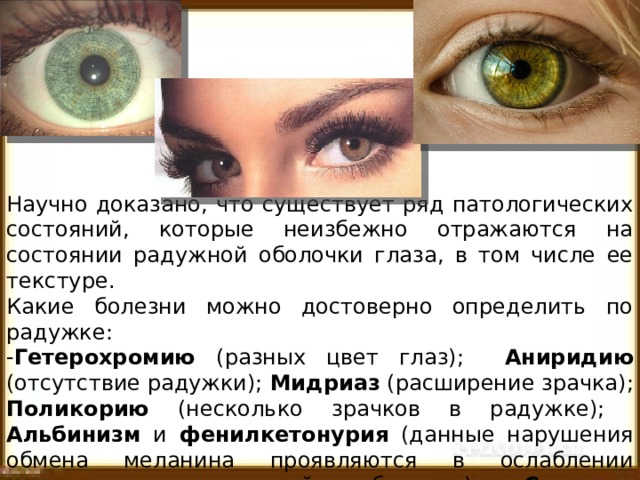 Научно доказано, что существует ряд патологических состояний, которые неизбежно отражаются на состоянии радужной оболочки глаза, в том числе ее текстуре. Какие болезни можно достоверно определить по радужке: - Гетерохромию (разных цвет глаз); Аниридию (отсутствие радужки); Мидриаз (расширение зрачка); Поликорию (несколько зрачков в радужке); Альбинизм и фенилкетонурия (данные нарушения обмена меланина проявляются в ослаблении пигментации радужной оболочки); Синдром Вильямса, синдром Горнера, синдром Ваарденбурга и прочие генетические заболевания. 