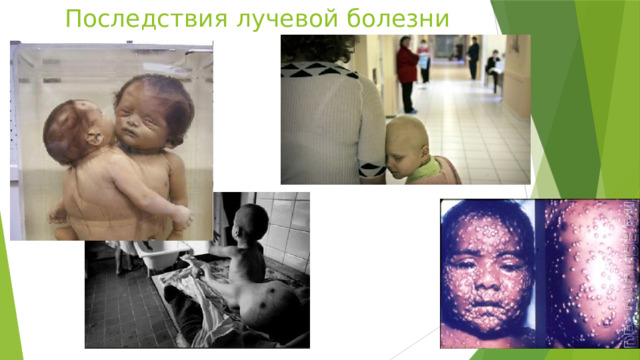 Последствия лучевой болезни 