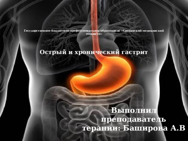 Государственное бюджетное профессиональное образование «Саткинский медицинский техникум»      Острый и хронический гастрит         Выполнил преподаватель терапии: Баширова А.В 