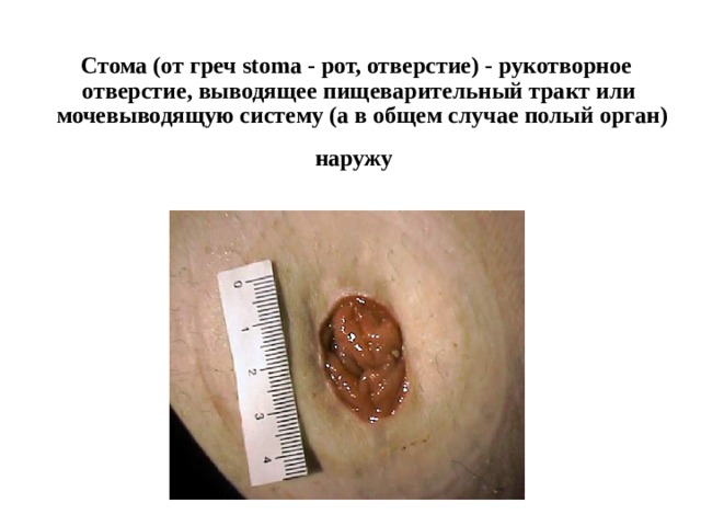 Стома (от греч stoma - рот, отверстие) - рукотворное  отверстие, выводящее пищеварительный тракт или  мочевыводящую систему (а в общем случае полый орган) наружу    
