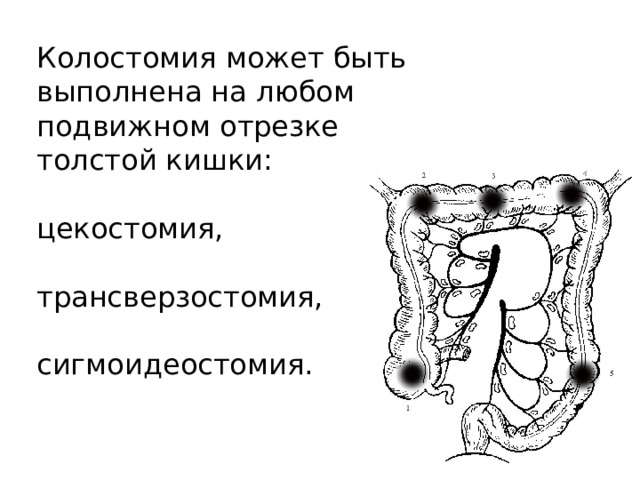 Колостомия может быть выполнена на любом подвижном отрезке толстой кишки:   цекостомия,   трансверзостомия,   сигмоидеостомия. 