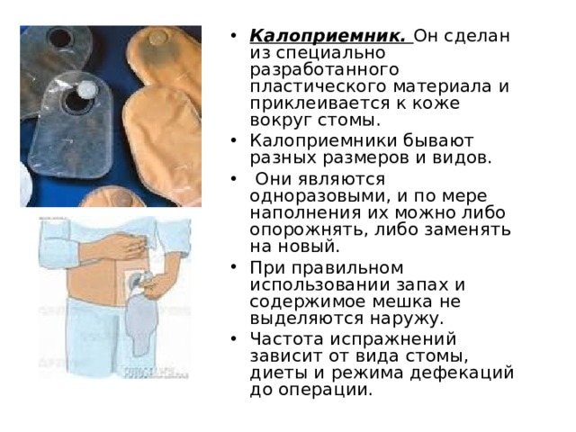 Калоприемник. Он сделан из специально разработанного пластического материала и приклеивается к коже вокруг стомы. Калоприемники бывают разных размеров и видов.  Они являются одноразовыми, и по мере наполнения их можно либо опорожнять, либо заменять на новый. При правильном использовании запах и содержимое мешка не выделяются наружу. Частота испражнений зависит от вида стомы, диеты и режима дефекаций до операции.  