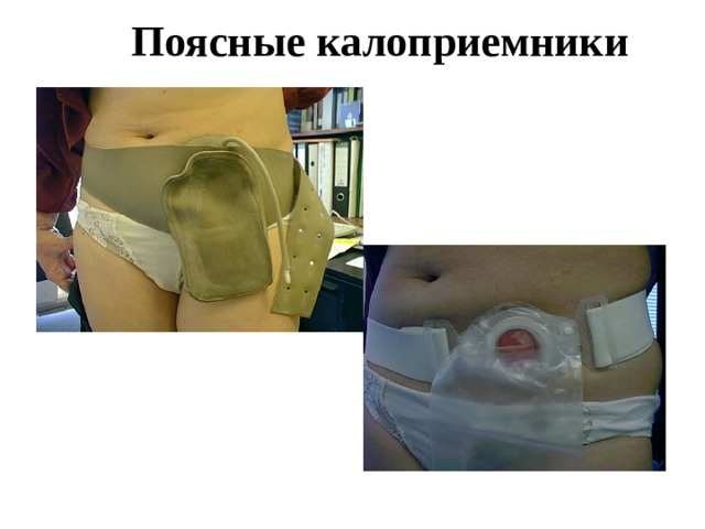 Поясные калоприемники 