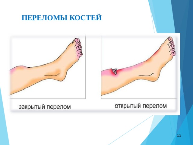 ПЕРЕЛОМЫ КОСТЕЙ  