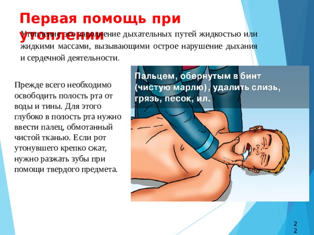 Первая помощь при утоплении Утопление это заполнение дыхательных путей жидкостью или жидкими массами, вызывающими острое нарушение дыхания и сердечной деятельности . Прежде всего необходимо освободить полость рта от воды и тины. Для этого глубоко в полость рта нужно ввести палец, обмотанный чистой тканью. Если рот утонувшего крепко сжат, нужно разжать зубы при помощи твердого предмета. 22 