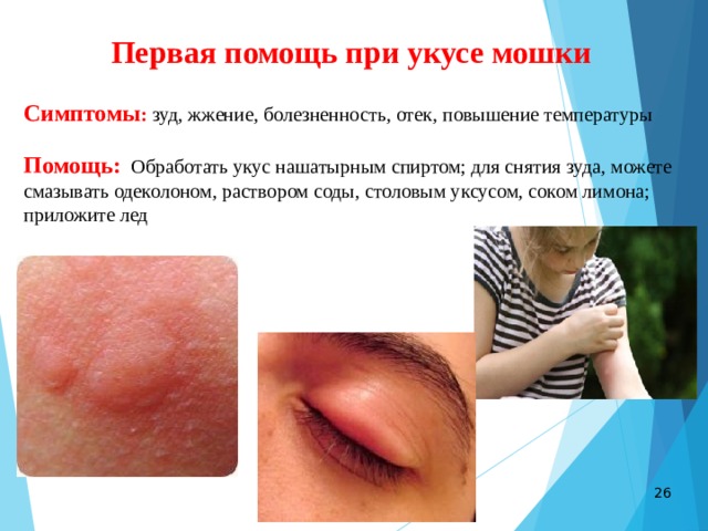 Первая помощь при укусе мошки  Симптомы : зуд, жжение, болезненность, отек, повышение температуры Помощь: Обработать укус нашатырным спиртом; для снятия зуда, можете смазывать одеколоном, раствором соды, столовым уксусом, соком лимона;  приложите лед  