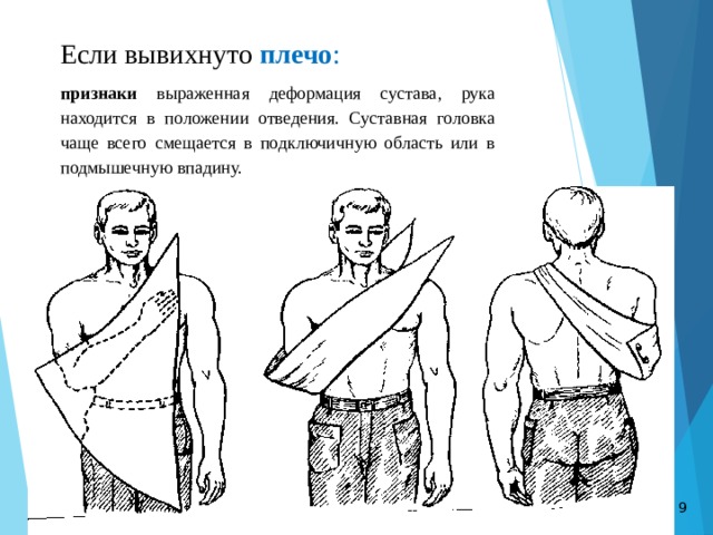 Если вывихнуто плечо :  признаки выраженная деформация сустава, рука находится в положении отведения. Суставная головка чаще всего смещается в подключичную область или в подмышечную впадину.  