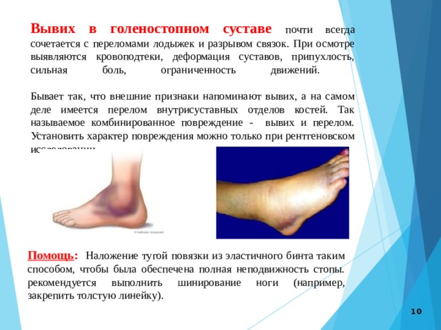 Вывих в голеностопном суставе почти всегда сочетается с переломами лодыжек и разрывом связок. При осмотре выявляются кровоподтеки, деформация суставов, припухлость, сильная боль, ограниченность движений.     Бывает так, что внешние признаки напоминают вывих, а на самом деле имеется перелом внутрисуставных отделов костей. Так называемое комбинированное повреждение - вывих и перелом. Установить характер повреждения можно только при рентгеновском исследовании. Помощь : Наложение тугой повязки из эластичного бинта таким способом, чтобы была обеспечена полная неподвижность стопы. рекомендуется выполнить шинирование ноги (например, закрепить толстую линейку).  