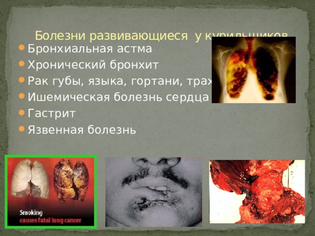 Болезни развивающиеся у курильщиков Бронхиальная астма Хронический бронхит Рак губы, языка, гортани, трахеи Ишемическая болезнь сердца Гастрит Язвенная болезнь 