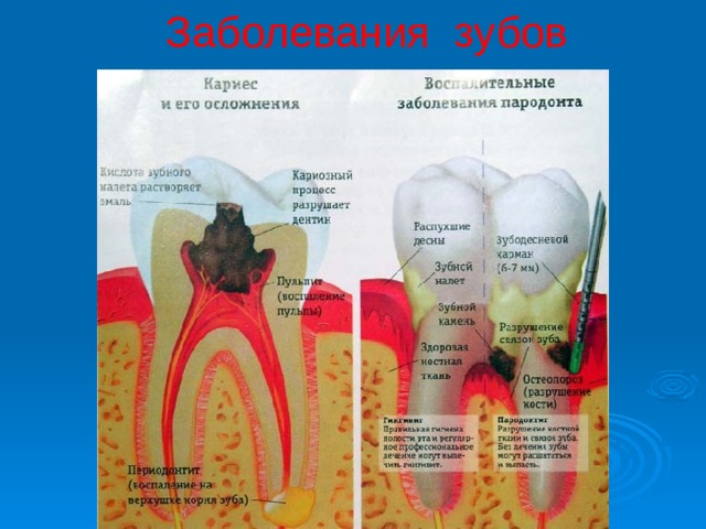 Заболевания зубов 