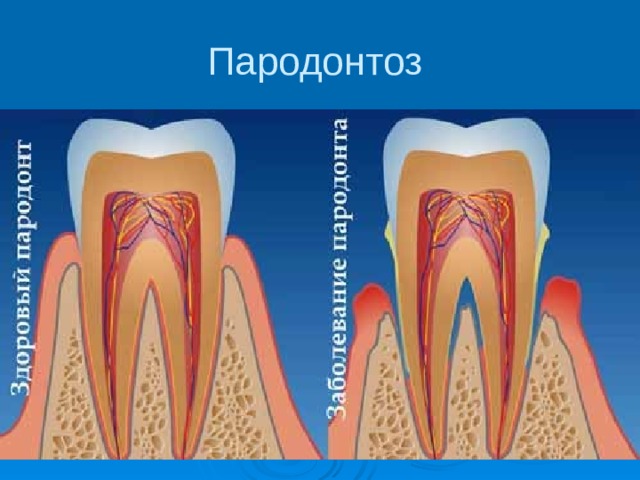 Пародонтоз 
