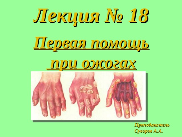 Лекция № 18 Первая помощь  при ожогах Преподаватель Суворов А.А. 