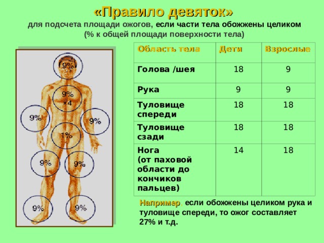 «Правило девяток»  для подсчета площади ожогов, если части тела  обожжены целиком  (% к общей площади поверхности тела) Область тела Голова /шея Дети Взрослые 18 Рука 9 9 Туловище спереди 9 18 Туловище сзади 18 Нога (от паховой области до кончиков пальцев) 18 14 18 18 Например , если обожжены целиком рука и туловище спереди, то ожог составляет 27% и т.д. 