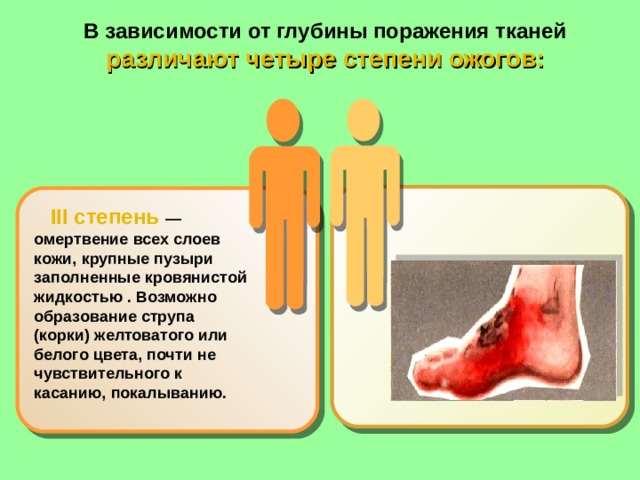 В зависимости от глубины поражения тканей различают четыре степени ожогов:       III степень — омертвение всех слоев кожи, крупные пузыри заполненные кровянистой жидкостью . Возможно образование струпа (корки) желтоватого или белого цвета, почти не чувствительного к касанию, покалыванию. 