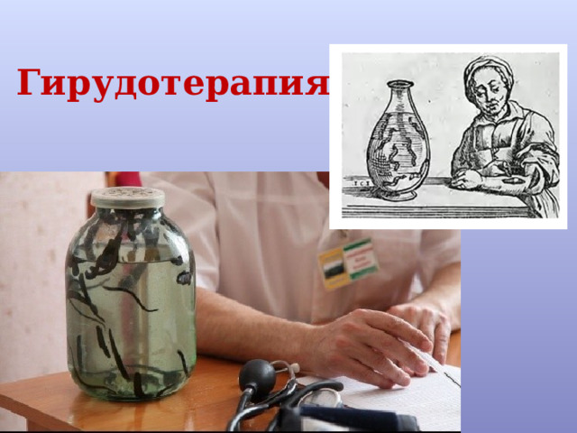 Гирудотерапия 