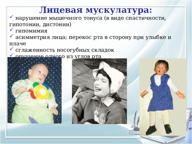 Лицевая мускулатура:  нарушение мышечного тонуса (в виде спастичности, гипотонии, дистонии)  гипомимия  асимметрия лица; перекос рта в сторону при улыбке и плаче  сглаженность носогубных складок  опущение одного из углов рта 