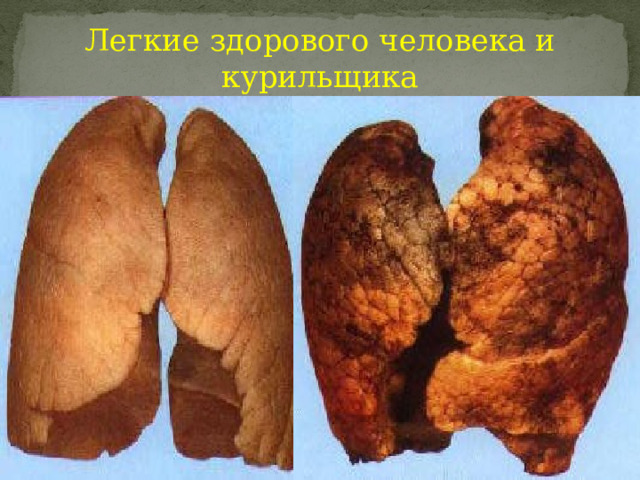 Легкие здорового человека и курильщика 