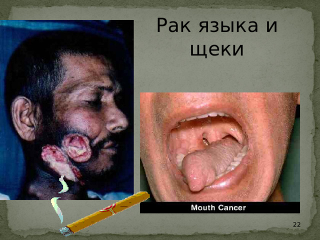 Рак языка и щеки  22 