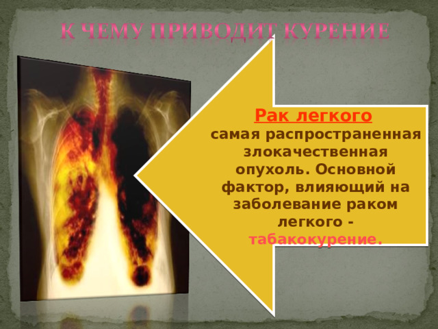 Рак легкого  самая распространен ная злокачественн ая опухол ь . Основной фактор, влияющий на заболевание раком легкого -  табакокурение. 