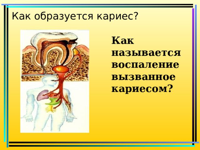 Как образуется кариес? Как называется воспаление вызванное кариесом?   