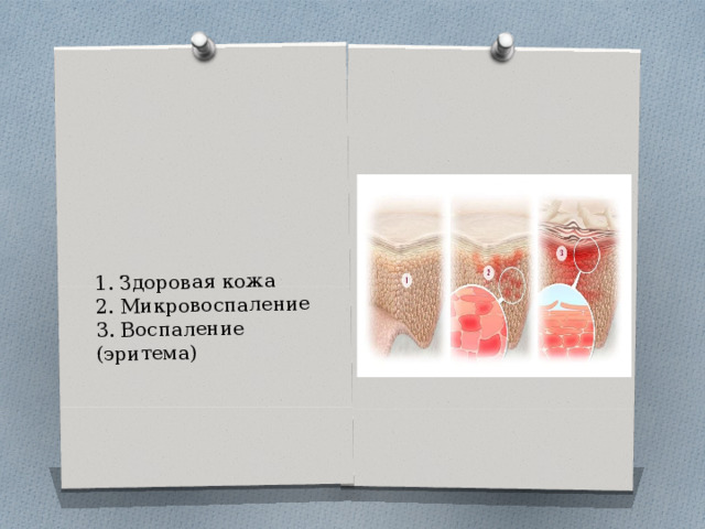 1. Здоровая кожа  2. Микровоспаление  3. Воспаление (эритема) 