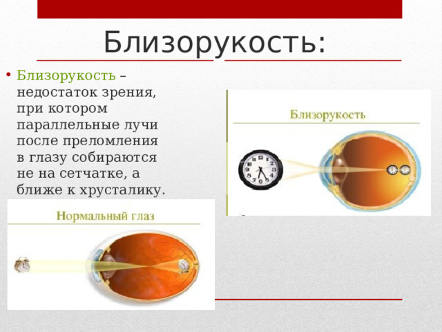 Близорукость: Близорукость – недостаток зрения, при котором параллельные лучи после преломления в глазу собираются не на сетчатке, а ближе к хрусталику. 