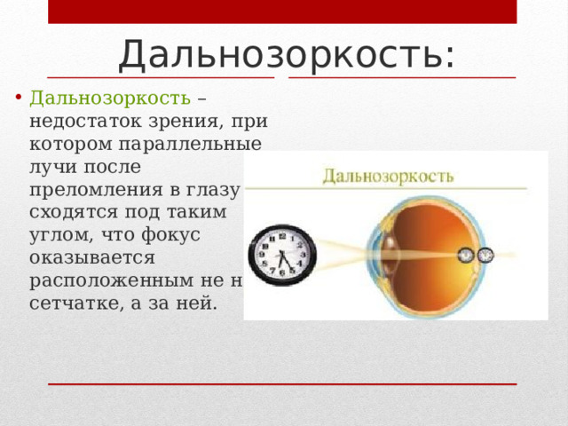 Дальнозоркость: Дальнозоркость – недостаток зрения, при котором параллельные лучи после преломления в глазу сходятся под таким углом, что фокус оказывается расположенным не на сетчатке, а за ней. 