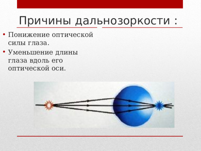 Причины дальнозоркости : Понижение оптической силы глаза. Уменьшение длины глаза вдоль его оптической оси. 