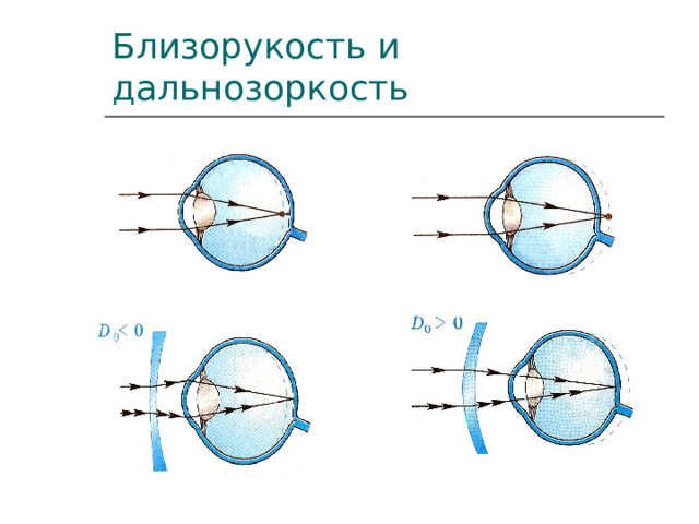 Близорукость и дальнозоркость 