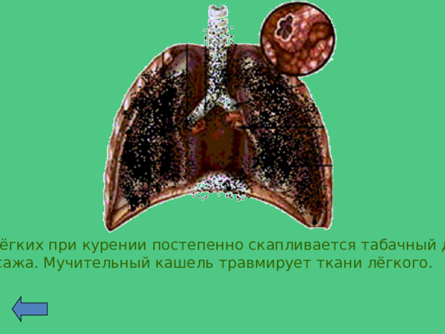 В лёгких при курении постепенно скапливается табачный дым  и сажа. Мучительный кашель травмирует ткани лёгкого. 