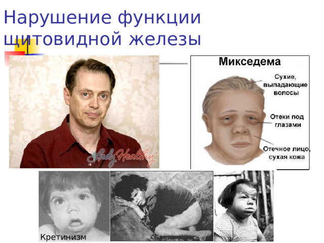 Нарушение функции щитовидной железы Кретинизм 
