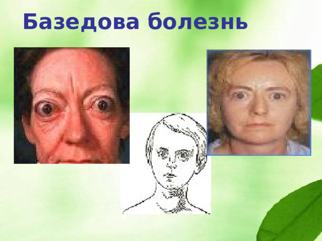Базедова болезнь 