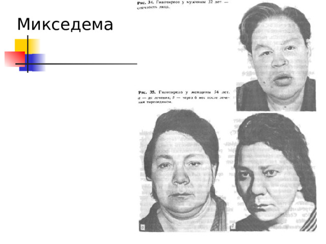 Микседема 