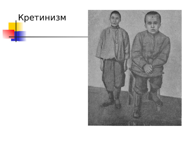 Кретинизм 