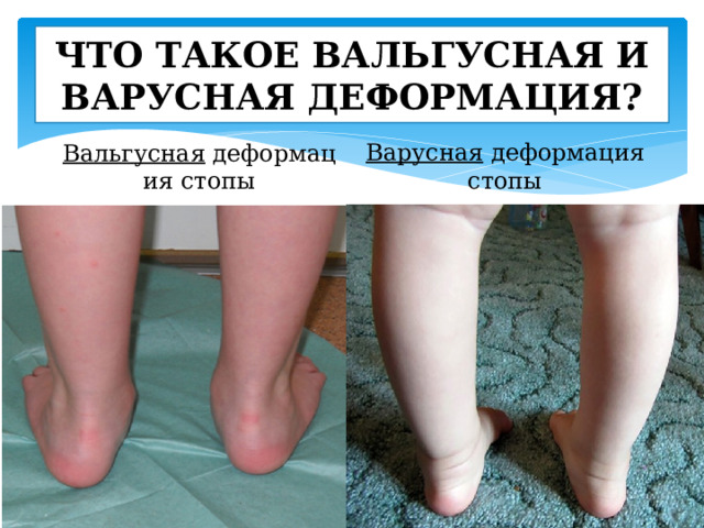 ЧТО ТАКОЕ ВАЛЬГУСНАЯ И ВАРУСНАЯ ДЕФОРМАЦИЯ? Варусная деформация стопы Вальгусная  деформация стопы 