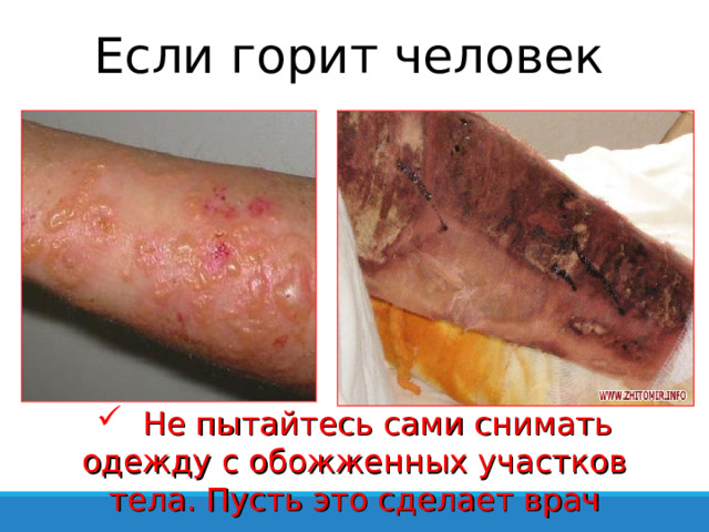 Если горит человек  Не пытайтесь сами снимать одежду с обожженных участков тела. Пусть это сделает врач 