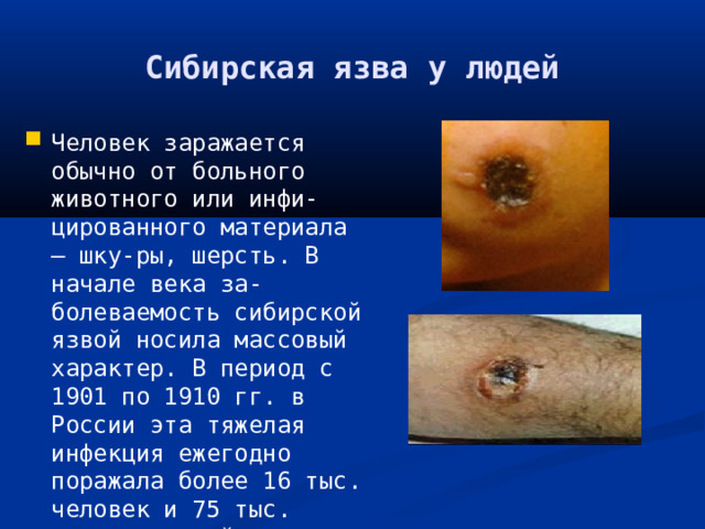Сибирская язва у людей Человек заражается обычно от больного животного или инфи-цированного материала – шку-ры, шерсть. В начале века за-болеваемость сибирской язвой носила массовый характер. В период с 1901 по 1910 гг. в России эта тяжелая инфекция ежегодно поражала более 16 тыс. человек и 75 тыс. сель-скохозяйственных животных. 