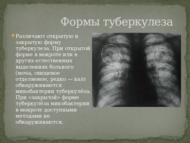  Формы туберкулеза Различают открытую и закрытую форму туберкулеза. При открытой форме в мокроте или в других естественных выделениях больного (моча, свищевое отделяемое, редко — кал) обнаруживаются микобактерии туберкулёза. При «закрытой» форме туберкулёза микобактерии в мокроте доступными методами не обнаруживаются. 