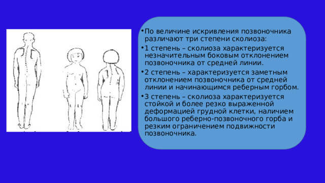 По величине искривления позвоночника различают три степени сколиоза: 1 степень – сколиоза характеризуется незначительным боковым отклонением позвоночника от средней линии. 2 степень – характеризуется заметным отклонением позвоночника от средней линии и начинающимся реберным горбом. 3 степень – сколиоза характеризуется стойкой и более резко выраженной деформацией грудной клетки, наличием большого реберно-позвоночного горба и резким ограничением подвижности позвоночника. 