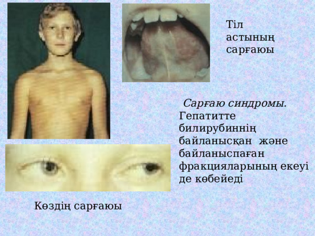 Тіл астының сарғаюы  Сарғаю синдромы. Гепатитте билирубиннің байланысқан және байланыспаған фракцияларының екеуі де көбейеді Көздің сарғаюы 