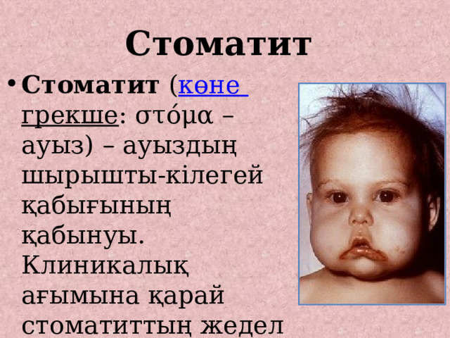 Стоматит Стоматит ( көне  грекше : στόμα – ауыз) – ауыздың шырышты-кілегей қабығының қабынуы. Клиникалық ағымына қарай стоматиттың жедел және созылмалы түрлері бар. 