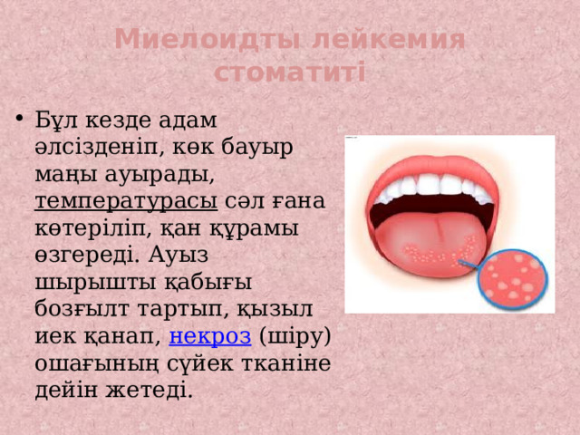 Миелоидты лейкемия стоматиті Бұл кезде адам әлсізденіп, көк бауыр маңы ауырады, температурасы сәл ғана көтеріліп, қан құрамы өзгереді. Ауыз шырышты қабығы бозғылт тартып, қызыл иек қанап, некроз (шіру) ошағының сүйек тканіне дейін жетеді. 