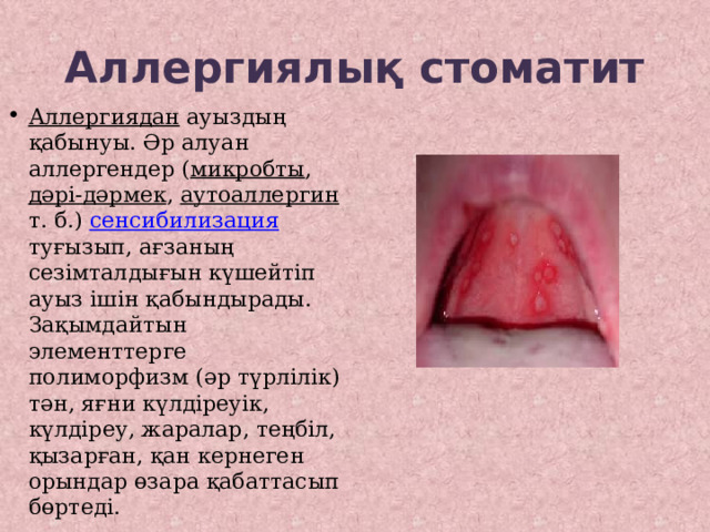 Аллергиялық стоматит Аллергиядан ауыздың қабынуы. Әр алуан аллергендер ( микробты , дәрі-дәрмек , аутоаллергин т. б.) сенсибилизация туғызып, ағзаның сезімталдығын күшейтіп ауыз ішін қабындырады. Зақымдайтын элементтерге полиморфизм (әр түрлілік) тән, яғни күлдіреуік, күлдіреу, жаралар, теңбіл, қызарған, қан кернеген орындар өзара қабаттасып бөртеді. 