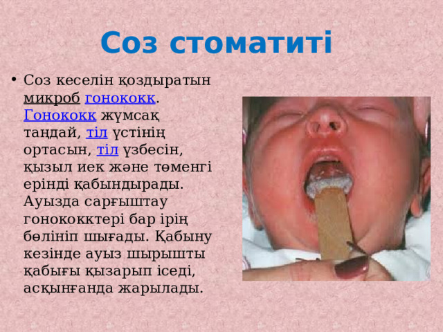 Соз стоматиті Соз кеселін қоздыратын микроб  гонококк . Гонококк жүмсақ таңдай, тіл үстінің ортасын, тіл үзбесін, қызыл иек және төменгі ерінді қабындырады. Ауызда сарғыштау гонококктері бар ірің бөлініп шығады. Қабыну кезінде ауыз шырышты қабығы қызарып іседі, асқынғанда жарылады. 
