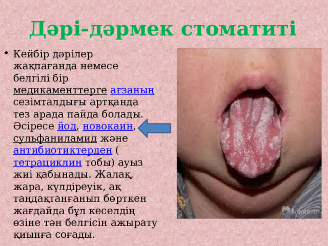 Дәрі-дәрмек стоматиті Кейбір дәрілер жақпағанда немесе белгілі бір медикаменттерге  ағзаның сезімталдығы артқанда тез арада пайда болады. Әсіресе йод , новокаин , сульфаниламид және антибиотиктерден ( тетрациклин тобы) ауыз жиі қабынады. Жалақ, жара, күлдіреуік, ақ таңдақтанғанып бөрткен жағдайда бұл кеселдің өзіне тән белгісін ажырату қиынға соғады. 
