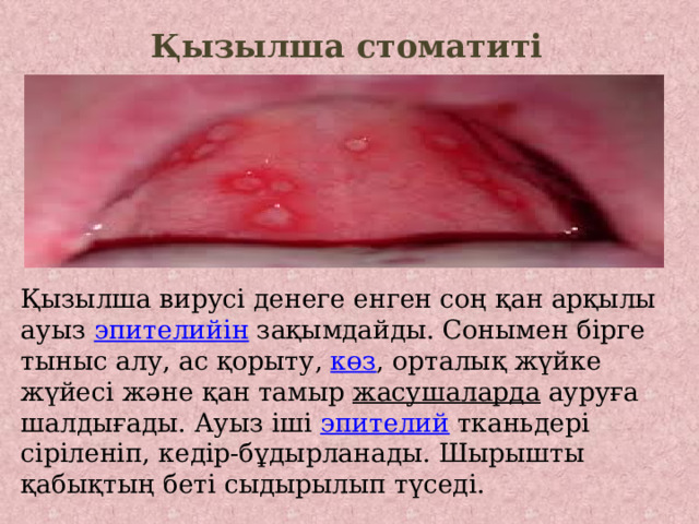 Қызылша стоматиті   Қызылша вирусі денеге енген соң қан арқылы ауыз эпителийін зақымдайды. Сонымен бірге тыныс алу, ас қорыту, көз , орталық жүйке жүйесі және қан тамыр жасушаларда ауруға шалдығады. Ауыз іші эпителий тканьдері сіріленіп, кедір-бұдырланады. Шырышты қабықтың беті сыдырылып түседі. 