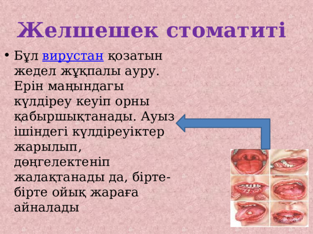 Желшешек стоматиті Бұл вирустан қозатын жедел жұқпалы ауру. Ерін маңындагы күлдіреу кеуіп орны қабыршықтанады. Ауыз ішіндегі күлдіреуіктер жарылып, дөңгелектеніп жалақтанады да, бірте-бірте ойық жараға айналады 